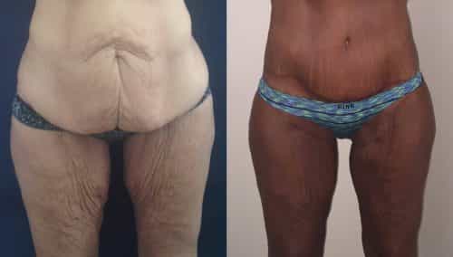 Before and after Thigh Lift Colombia - Premium Care Plastic Surgery