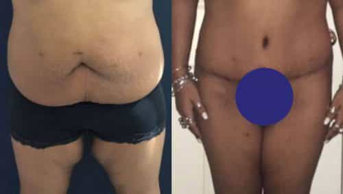 Before and after Thigh Lift Colombia - Premium Care Plastic Surgery