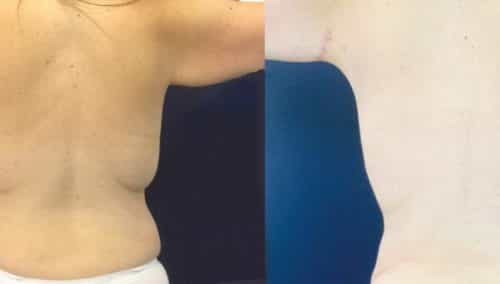Arm lift gallery - Before and After Arm Lift Colombia - Premium Care Plastic Surgery
