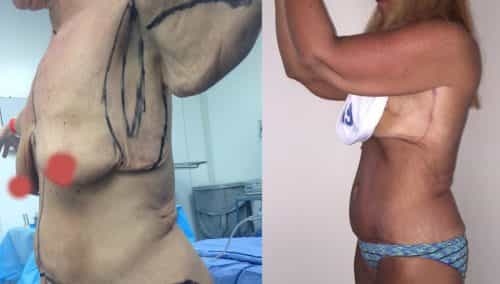Arm lift gallery - Before and After Arm Lift Colombia - Premium Care Plastic Surgery