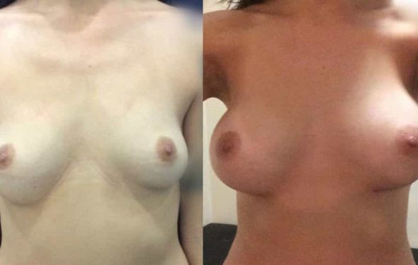 Breast Augmentation Colombia - Premium Care Plastic Surgery