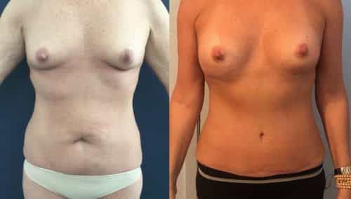 Breast Augmentation Colombia - Premium Care Plastic Surgery