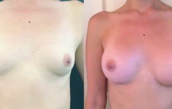 Breast Augmentation Colombia - Premium Care Plastic Surgery