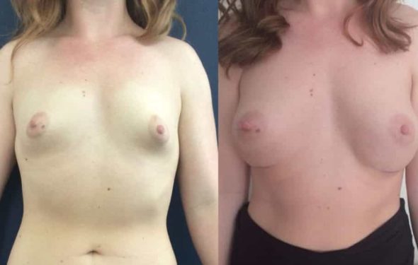 Breast Augmentation Colombia - Premium Care Plastic Surgery