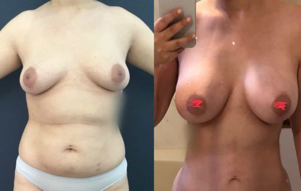 Breast Augmentation Colombia - Premium Care Plastic Surgery
