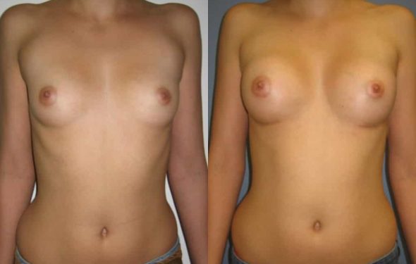 Breast Augmentation Colombia - Premium Care Plastic Surgery