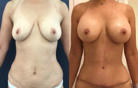Breast Augmentation Colombia - Premium Care Plastic Surgery