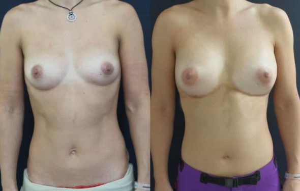 Breast Augmentation Colombia - Premium Care Plastic Surgery