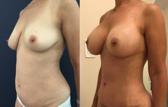 Breast Augmentation Colombia - Premium Care Plastic Surgery