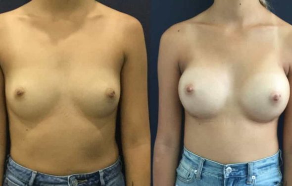 Breast Augmentation Colombia - Premium Care Plastic Surgery