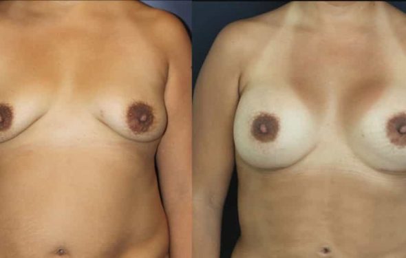 Breast Augmentation Colombia - Premium Care Plastic Surgery