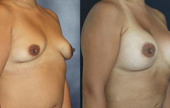 Breast Augmentation Colombia - Premium Care Plastic Surgery