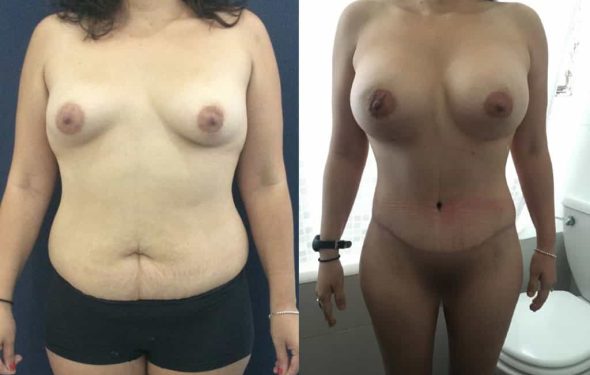 Breast Augmentation Colombia - Premium Care Plastic Surgery