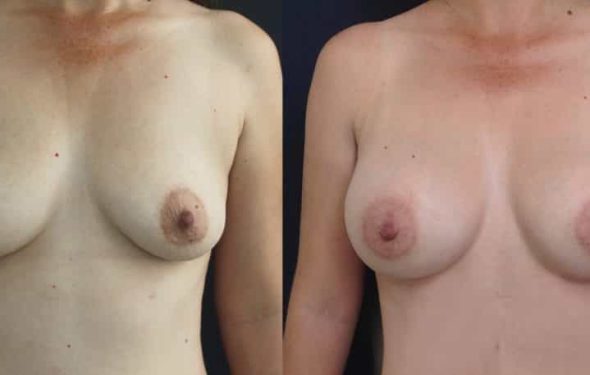 Breast Augmentation Colombia - Premium Care Plastic Surgery