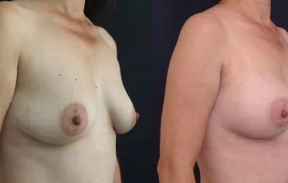Breast Augmentation Colombia - Premium Care Plastic Surgery