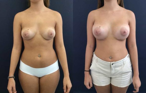 Breast Augmentation Colombia - Premium Care Plastic Surgery