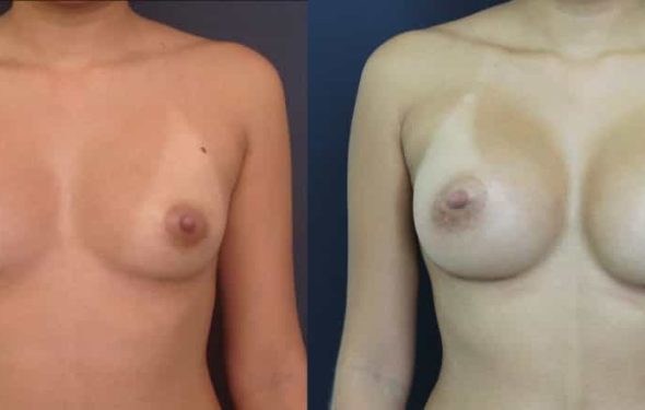 Breast Augmentation Colombia - Premium Care Plastic Surgery
