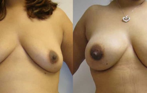 Breast Augmentation Colombia - Premium Care Plastic Surgery