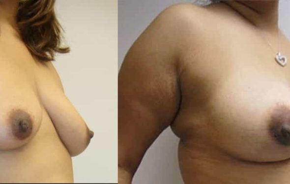 Breast Augmentation Colombia - Premium Care Plastic Surgery