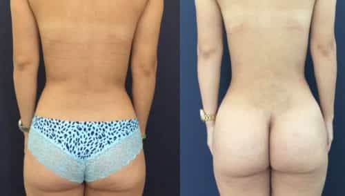Before and After brazilian butt lift Colombia - Premium Care Plastic Surgery