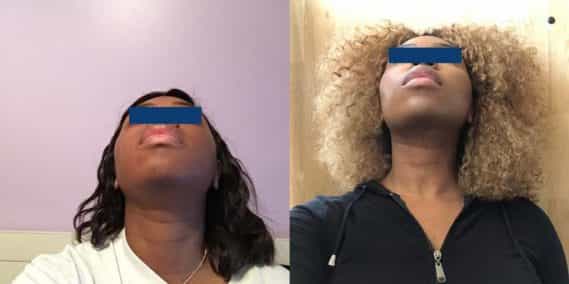 Before and After Buccal Fat Removal Colombia - Premium Care Plastic Surgery