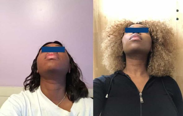 Before and After Buccal Fat Removal Colombia - Premium Care Plastic Surgery