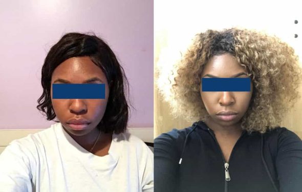 Before and After Buccal Fat Removal Colombia - Premium Care Plastic Surgery