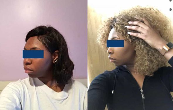 Before and After Buccal Fat Removal Colombia - Premium Care Plastic Surgery