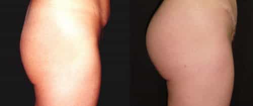 Before and After - Butt Implants Colombia - Premium Care Plastic Surgery