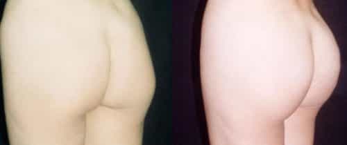 Before and After - Butt Implants Colombia - Premium Care Plastic Surgery