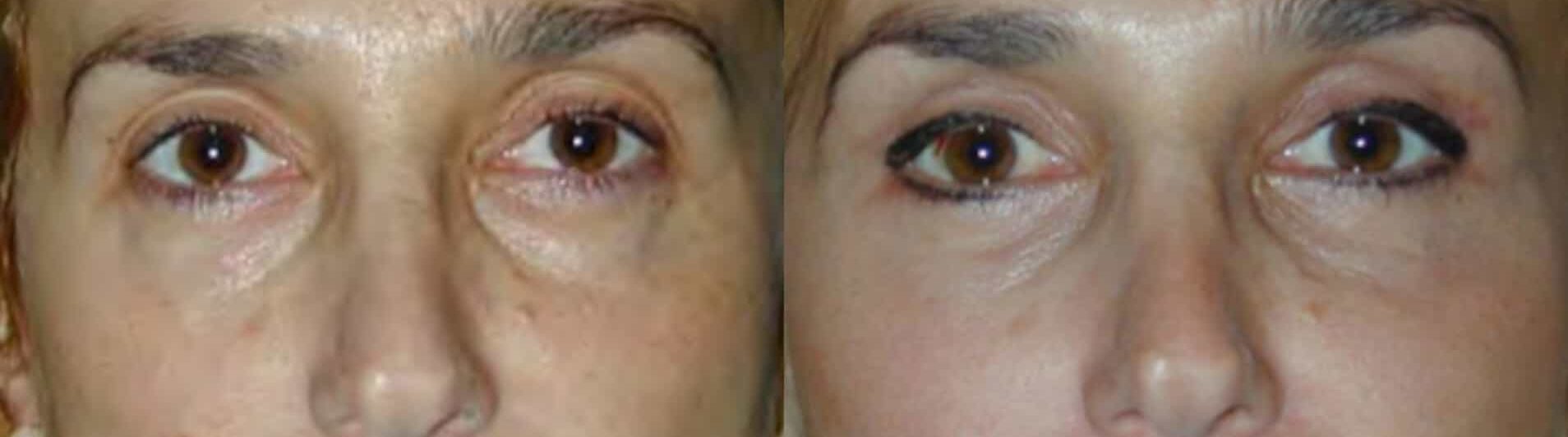 before and after Eyelid Surgery Colombia - Premium Care Plastic Surgery