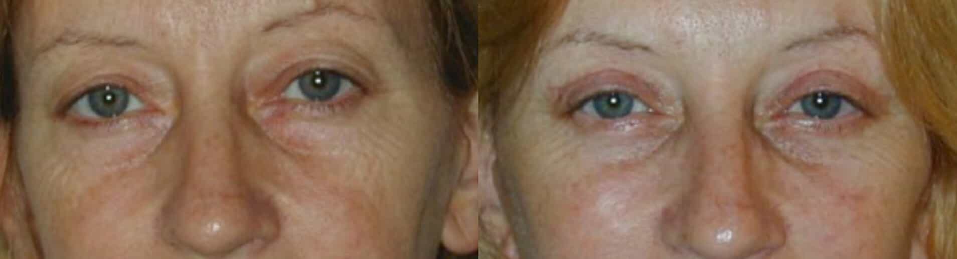 before and after Eyelid Surgery Colombia - Premium Care Plastic Surgery