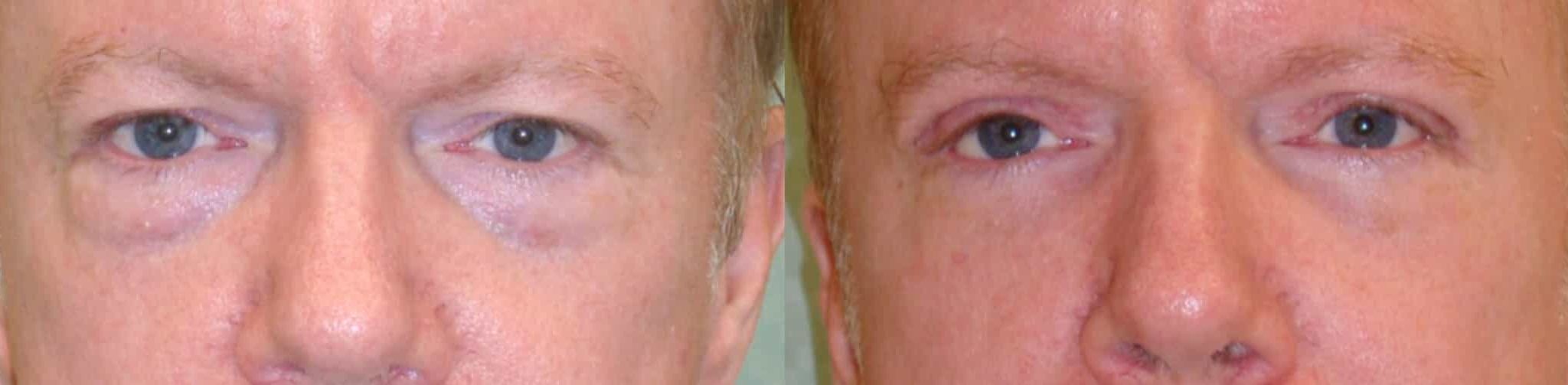 before and after Eyelid Surgery Colombia - Premium Care Plastic Surgery