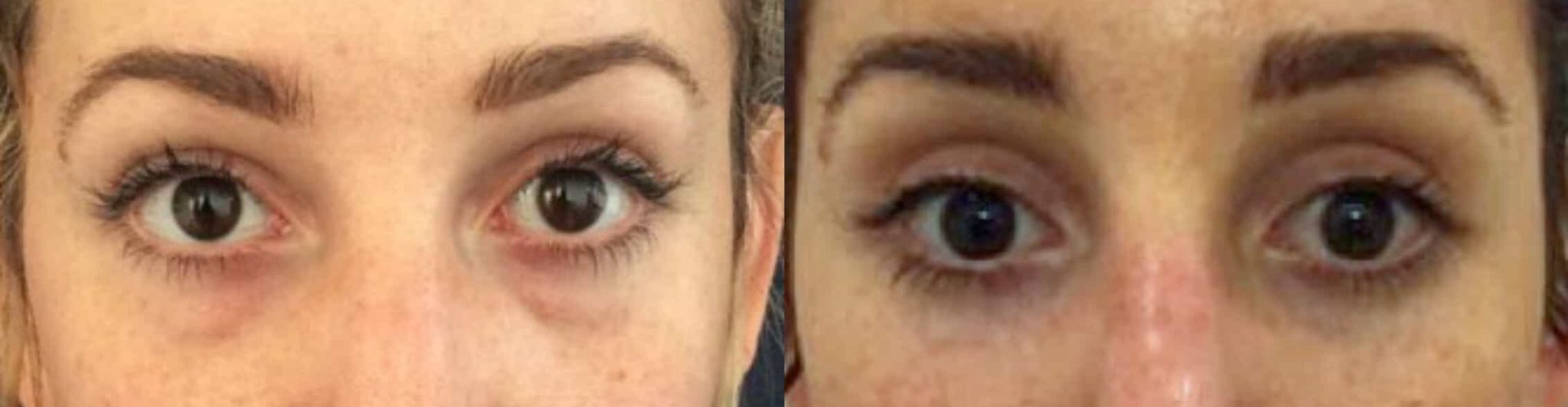 before and after Eyelid Surgery Colombia - Premium Care Plastic Surgery