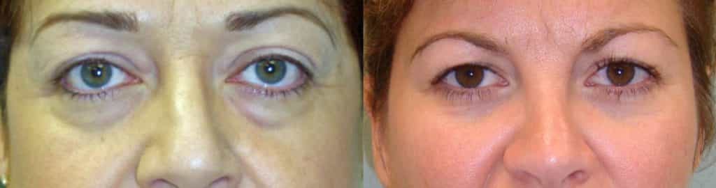 before and after Eyelid Surgery Colombia - Premium Care Plastic Surgery