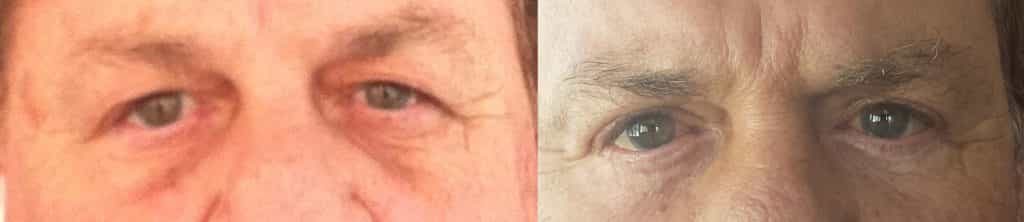 before and after Eyelid Surgery Colombia - Premium Care Plastic Surgery