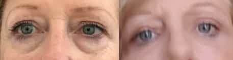 before and after Eyelid Surgery Colombia - Premium Care Plastic Surgery