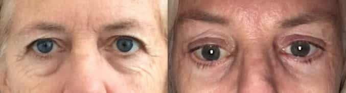 before and after Eyelid Surgery Colombia - Premium Care Plastic Surgery