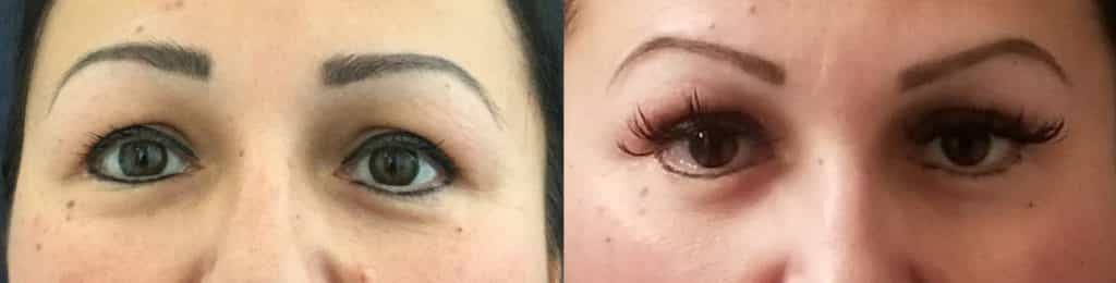 before and after Eyelid Surgery Colombia - Premium Care Plastic Surgery