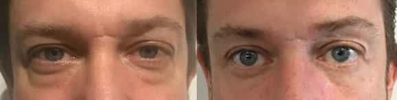 before and after Eyelid Surgery Colombia - Premium Care Plastic Surgery
