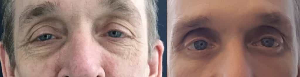 before and after Eyelid Surgery Colombia - Premium Care Plastic Surgery