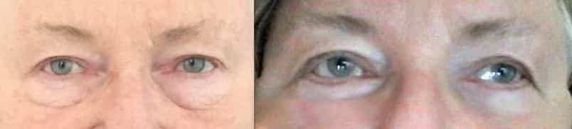 before and after Eyelid Surgery Colombia - Premium Care Plastic Surgery