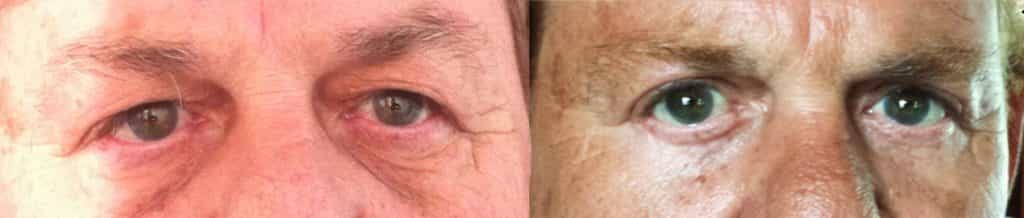before and after Eyelid Surgery Colombia - Premium Care Plastic Surgery