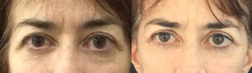 before and after Eyelid Surgery Colombia - Premium Care Plastic Surgery