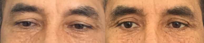 before and after Eyelid Surgery Colombia - Premium Care Plastic Surgery