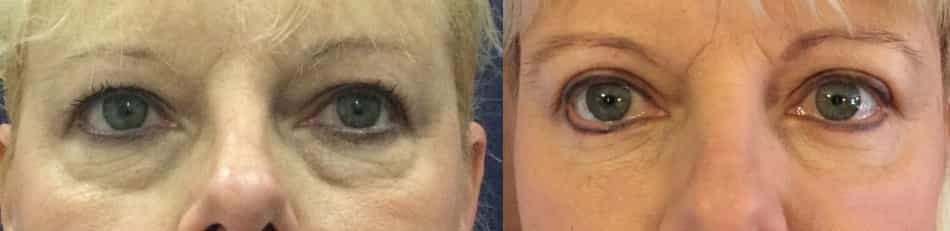 before and after Eyelid Surgery Colombia - Premium Care Plastic Surgery