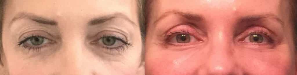 before and after Eyelid Surgery Colombia - Premium Care Plastic Surgery