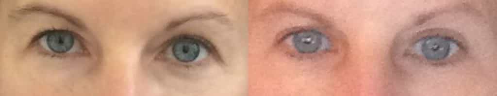 before and after Eyelid Surgery Colombia - Premium Care Plastic Surgery