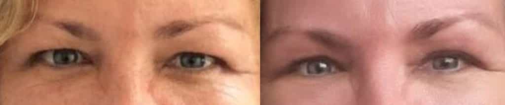 before and after Eyelid Surgery Colombia - Premium Care Plastic Surgery
