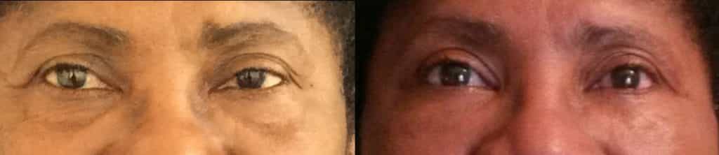 before and after Eyelid Surgery Colombia - Premium Care Plastic Surgery